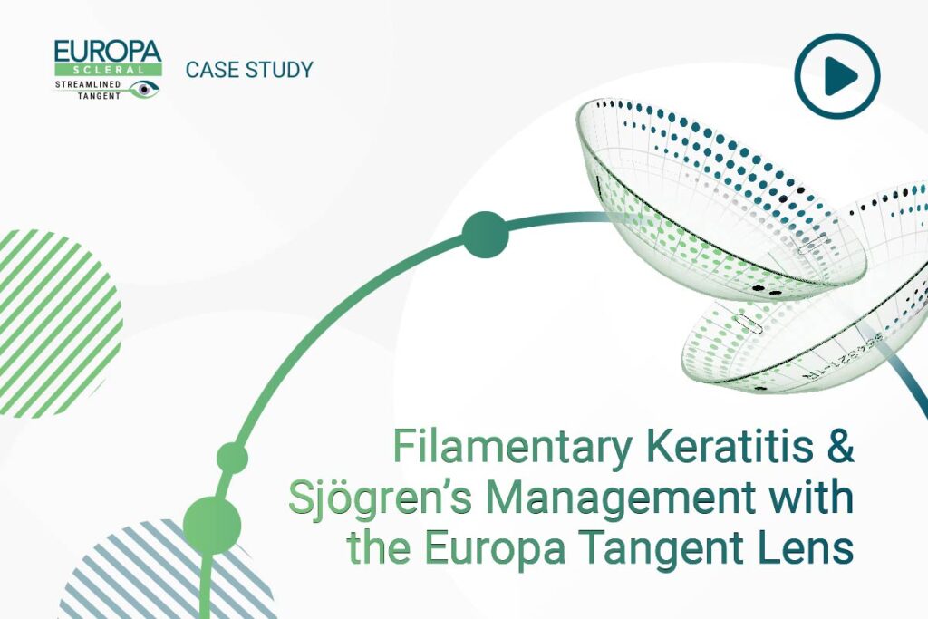 Filamentary Keratitis and Sjogrens Management with the Europa Tangent Lens